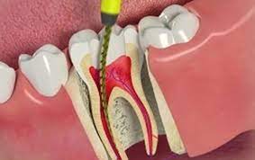 Root Canal Techniques