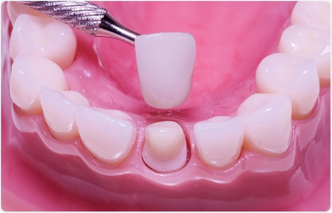 TYPES OF DENTAL CROWNS AND COST: A COMPLETE GUIDE